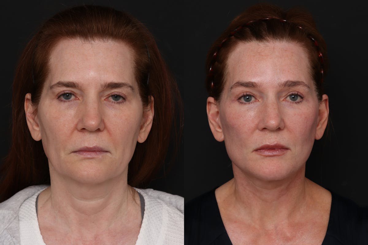 Facelift Before & After Gallery - Patient 174700 - Image 3
