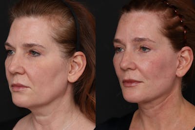 Brow Lift Before & After Gallery - Patient 122386 - Image 1