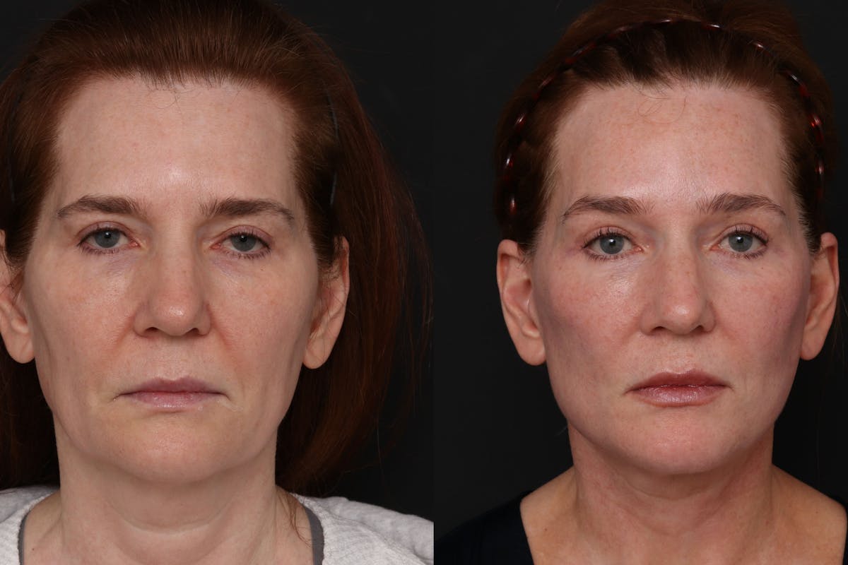 Brow Lift Before & After Gallery - Patient 122386 - Image 2