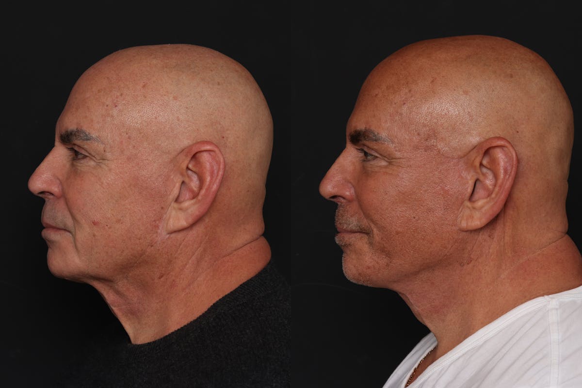 Facelift Before & After Gallery - Patient 261378 - Image 1