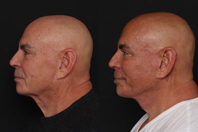Facelift Before & After Gallery - Patient 261378 - Image 1