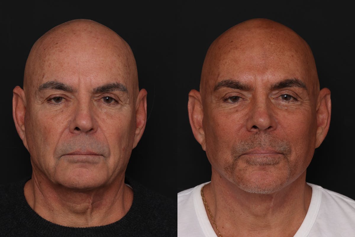 Facelift Before & After Gallery - Patient 261378 - Image 2