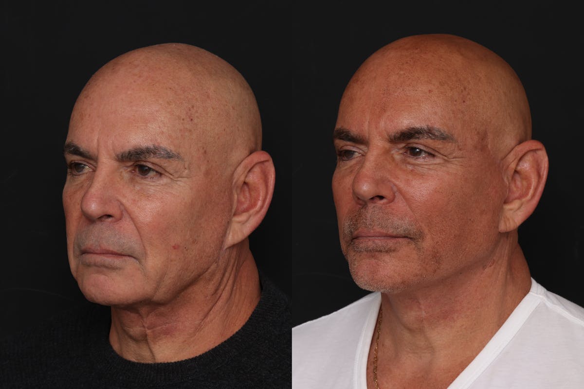 Facelift Before & After Gallery - Patient 261378 - Image 2