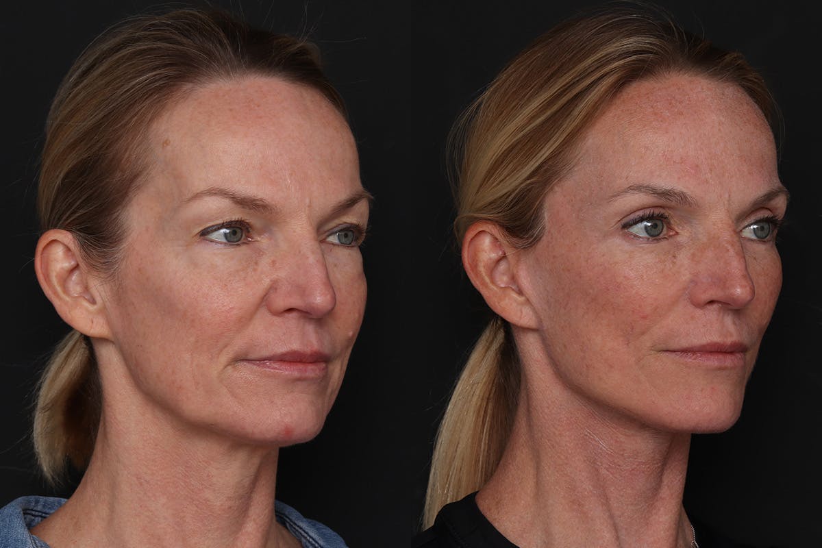 Facelift Before & After Gallery - Patient 194810 - Image 1