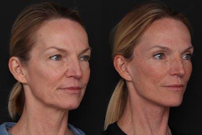 Facelift Before & After Gallery - Patient 194810 - Image 1