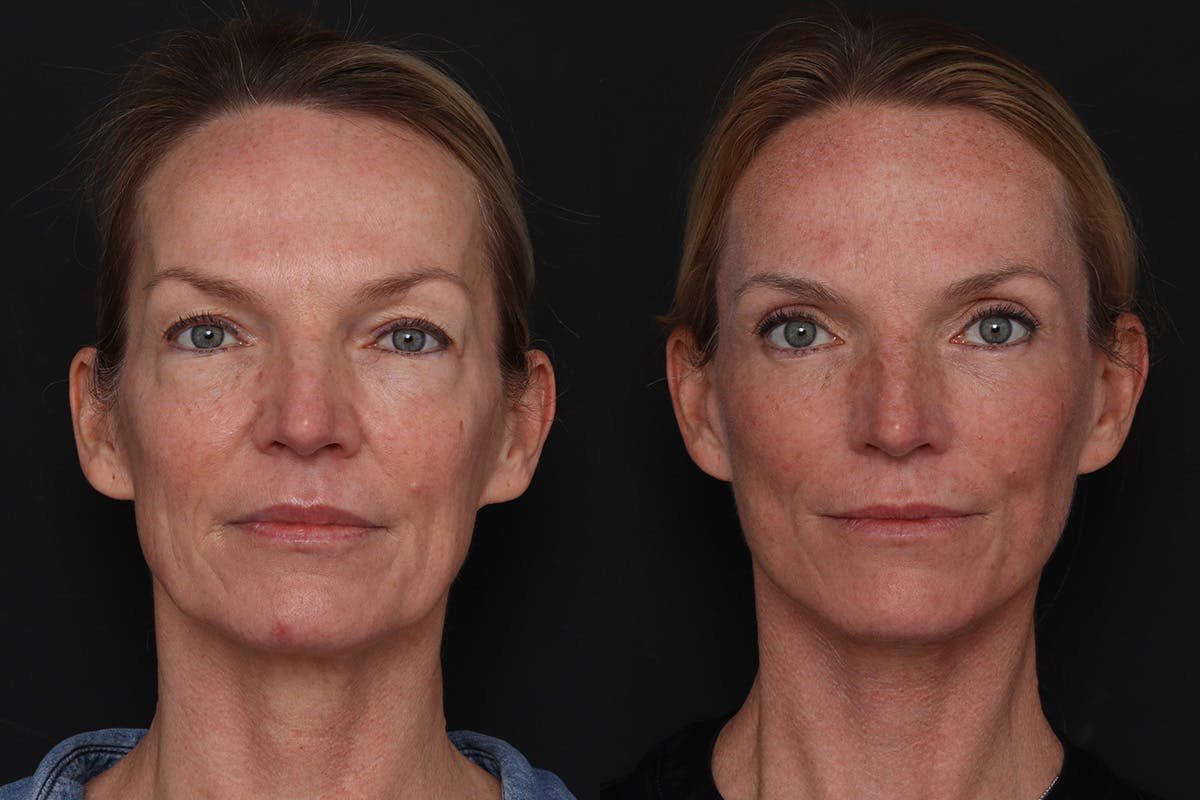 Facelift Before & After Gallery - Patient 194810 - Image 2