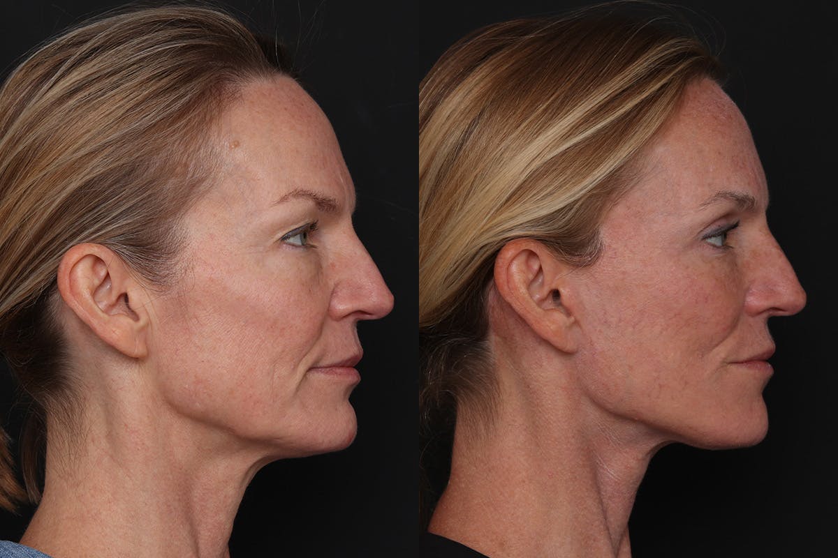 Facelift Before & After Gallery - Patient 194810 - Image 3