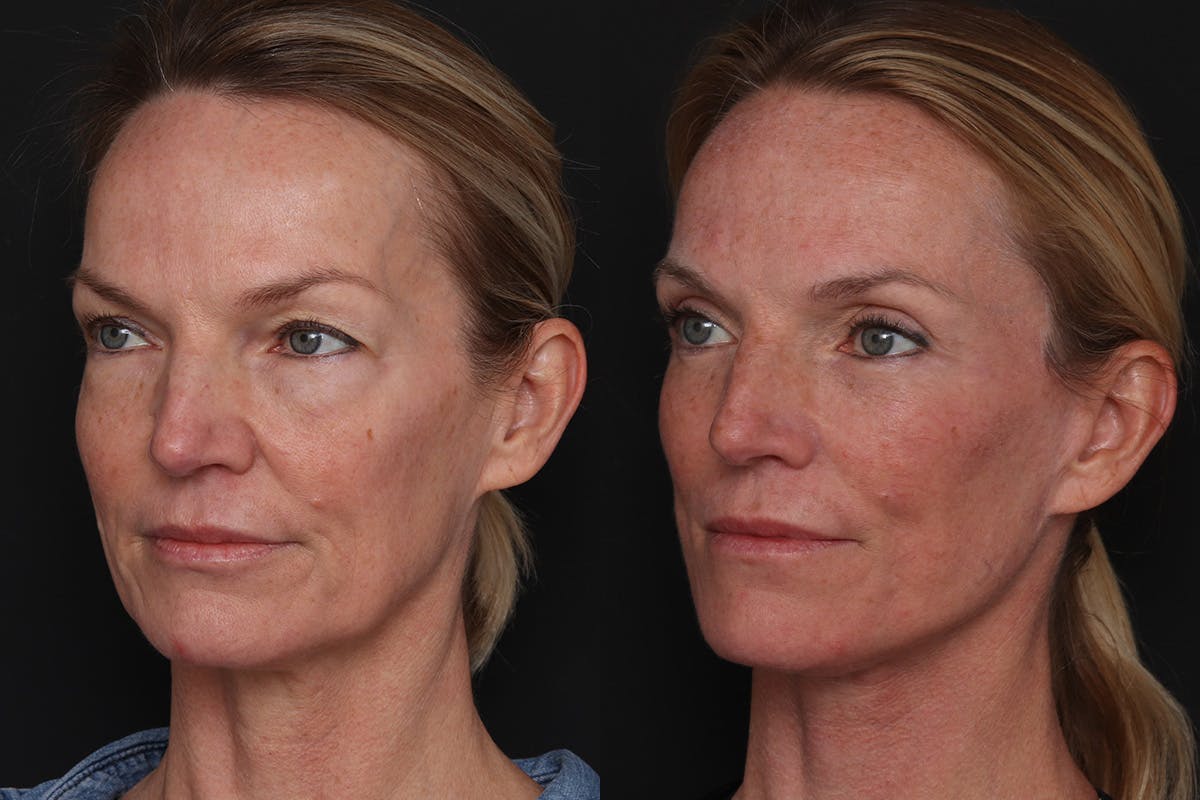 Facelift Before & After Gallery - Patient 194810 - Image 4