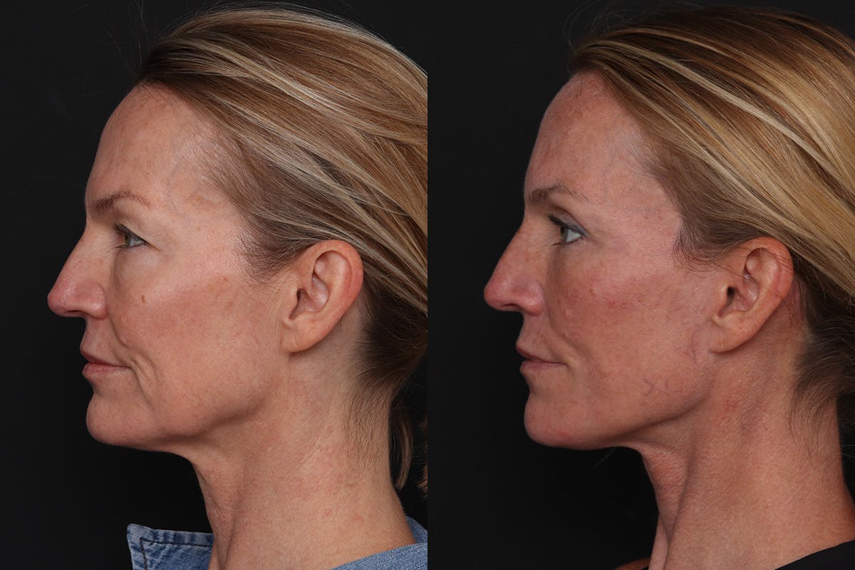 Facelift Before & After Gallery - Patient 194810 - Image 5