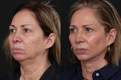 Facelift Before & After Gallery - Patient 385324 - Image 1
