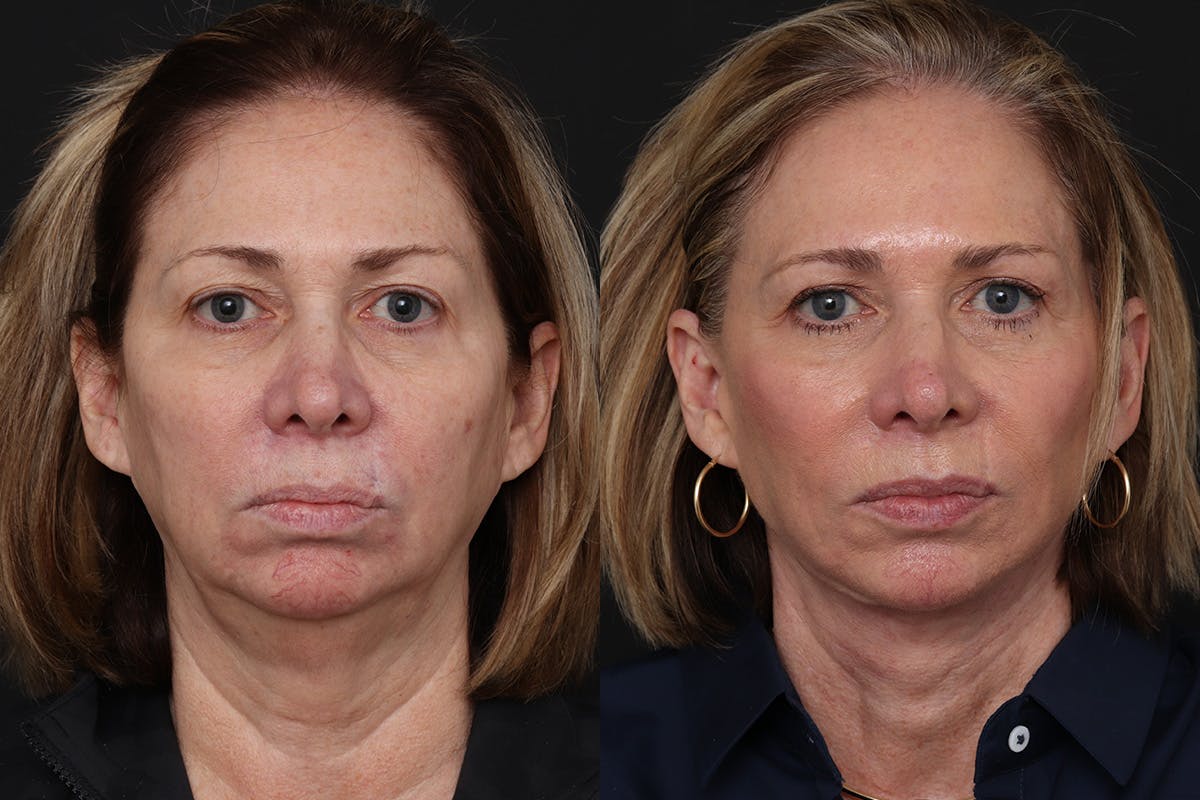 Facelift Before & After Gallery - Patient 385324 - Image 2