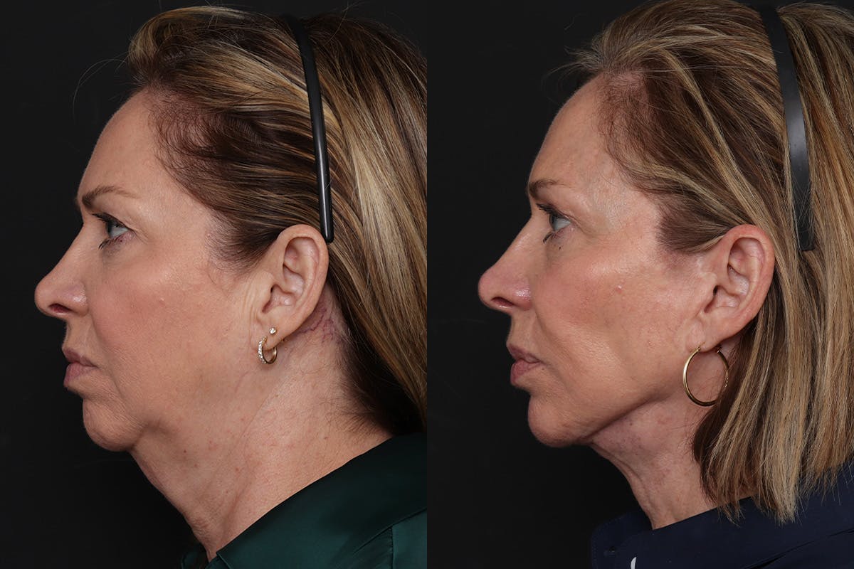 Facelift Before & After Gallery - Patient 385324 - Image 3