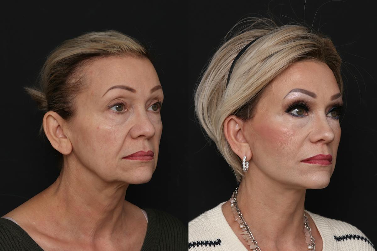 Facelift Before & After Gallery - Patient 321044 - Image 2