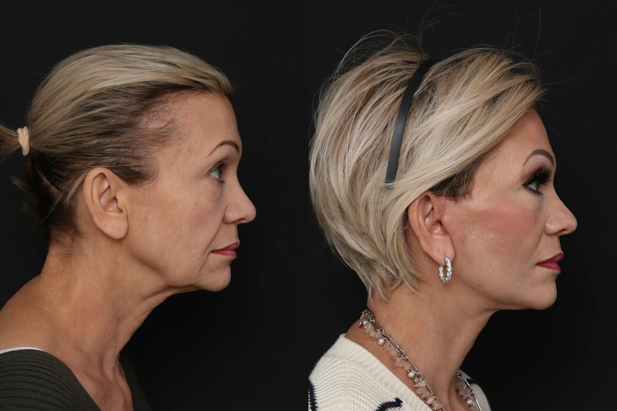 Facelift Before & After Gallery - Patient 321044 - Image 1