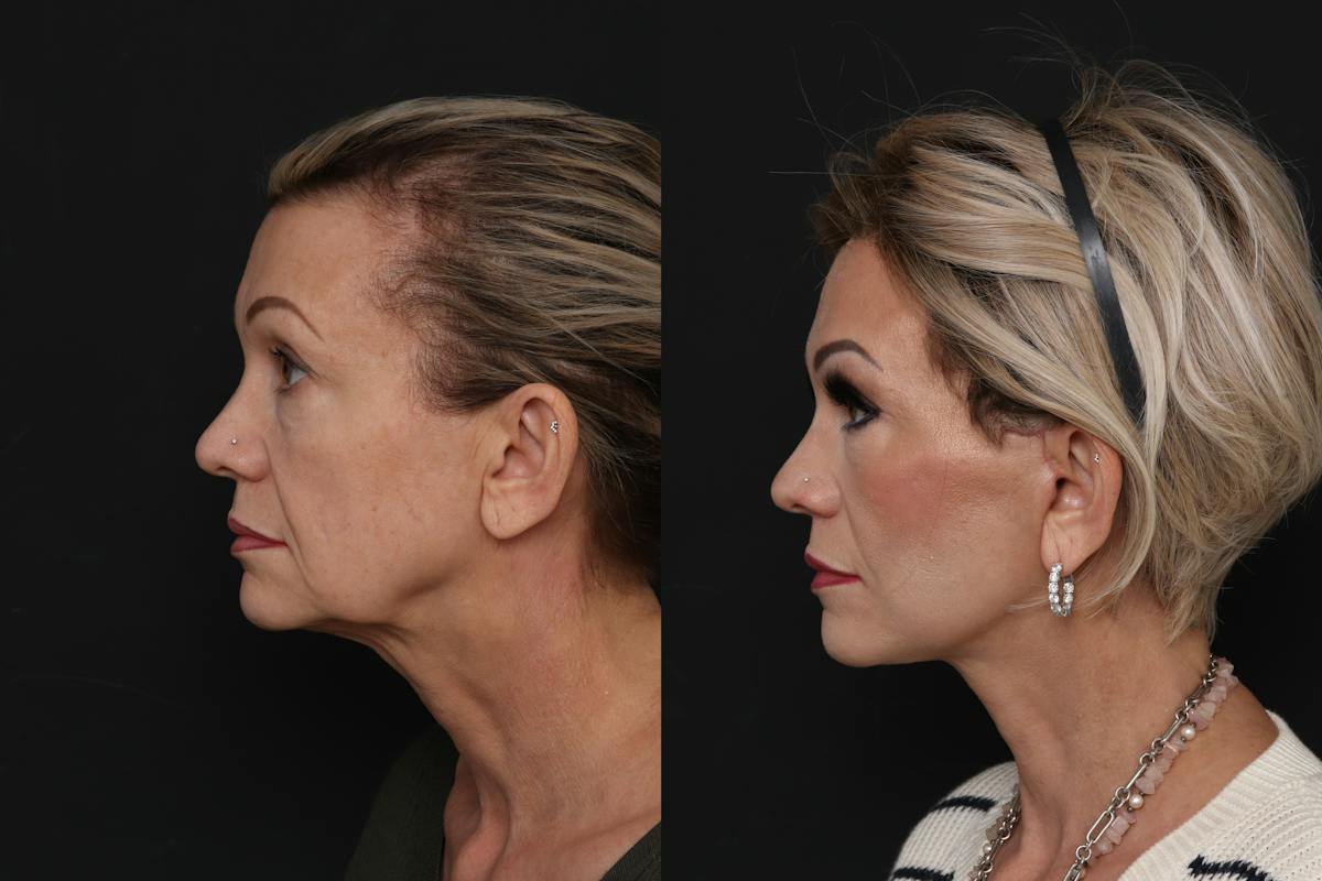 Facelift Before & After Gallery - Patient 321044 - Image 5