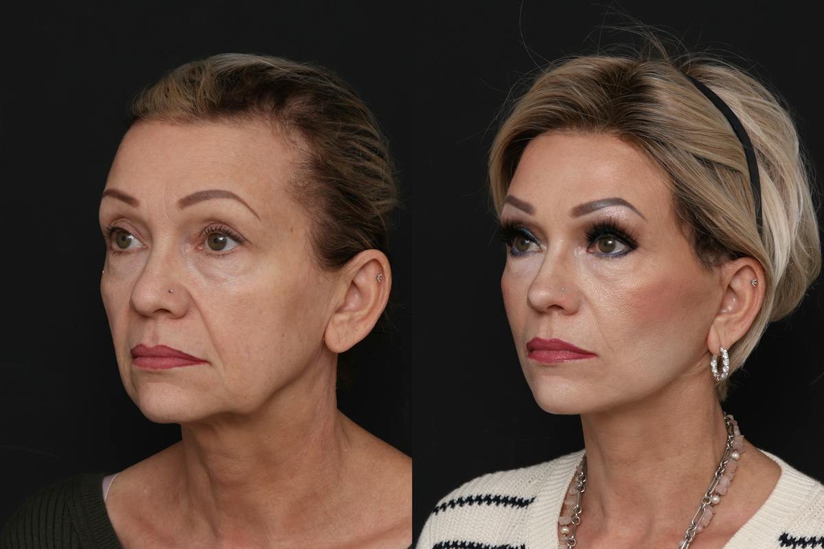 Facelift Before & After Gallery - Patient 321044 - Image 4