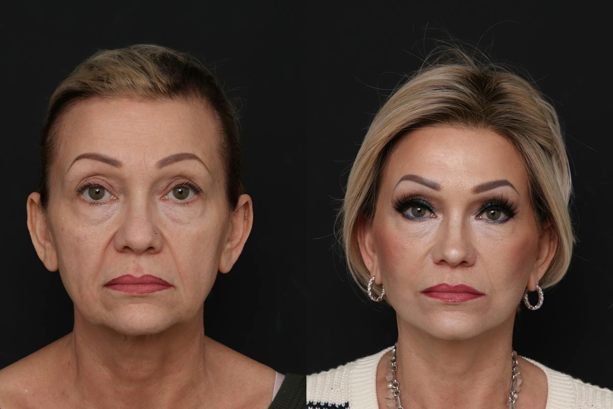 Facelift Before & After Gallery - Patient 321044 - Image 3
