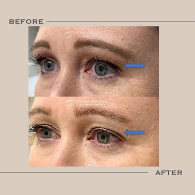 Lower Blepharoplasty Before & After Gallery - Patient 275066 - Image 1