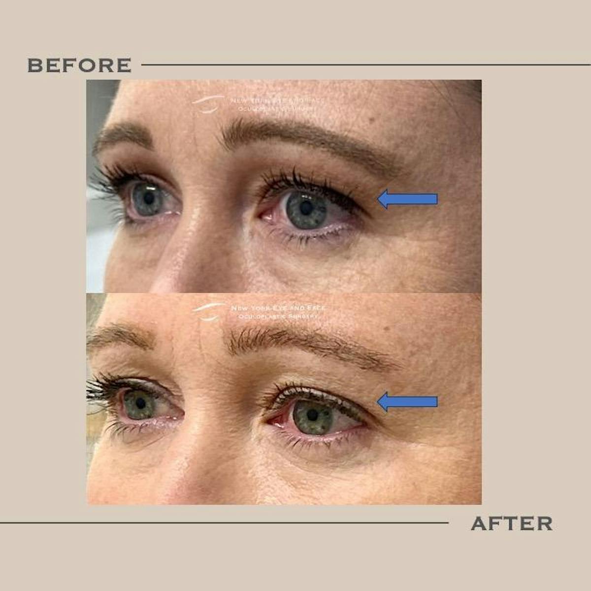 Upper Blepharoplasty Before & After Gallery - Patient 273780 - Image 1