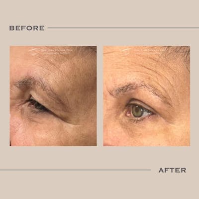 Upper Blepharoplasty Before & After Gallery - Patient 277098 - Image 1