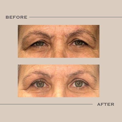 Upper Blepharoplasty Before & After Gallery - Patient 237176 - Image 1