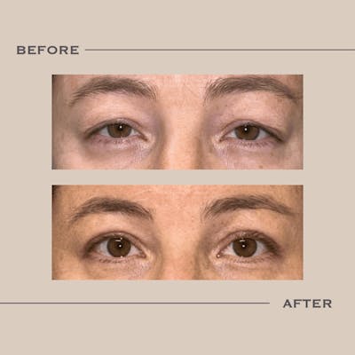 Upper Blepharoplasty Before & After Gallery - Patient 394641 - Image 1