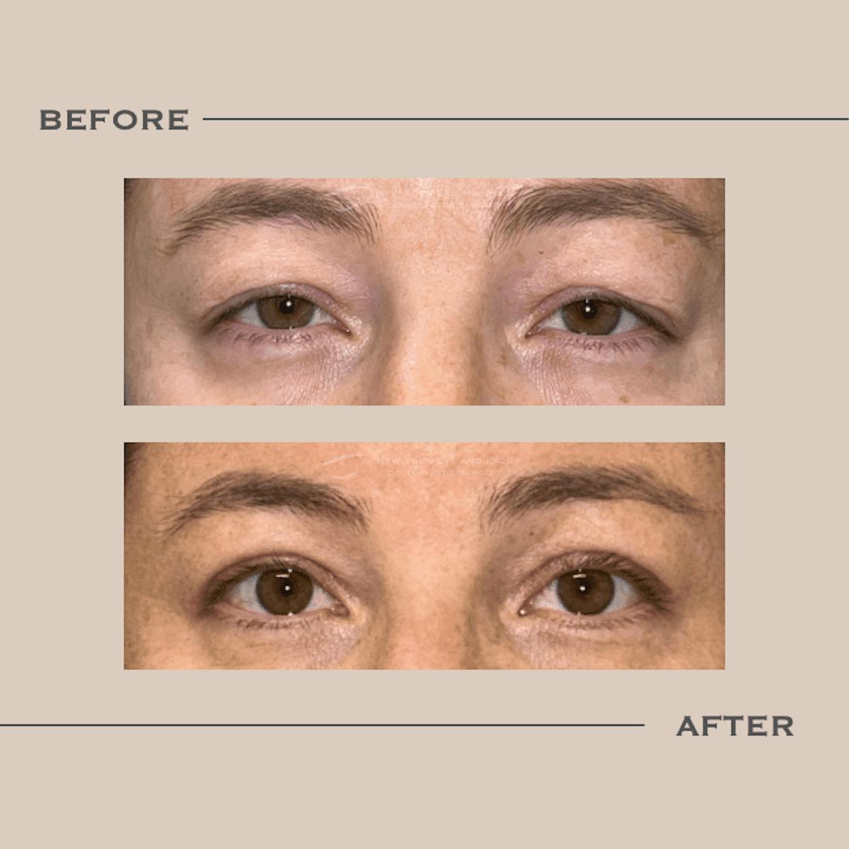 Upper Blepharoplasty Before & After Gallery - Patient 394641 - Image 1