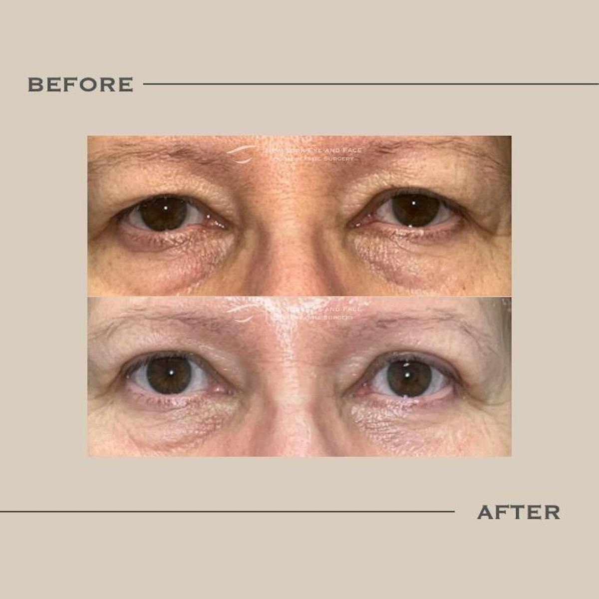 Upper Blepharoplasty Before & After Gallery - Patient 245083 - Image 1