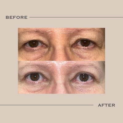 Upper Blepharoplasty Before & After Gallery - Patient 245083 - Image 1