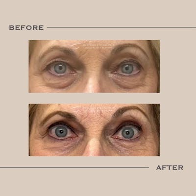 Upper Blepharoplasty Before & After Gallery - Patient 415587 - Image 1