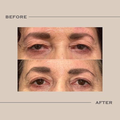 Upper Blepharoplasty Before & After Gallery - Patient 403473 - Image 1
