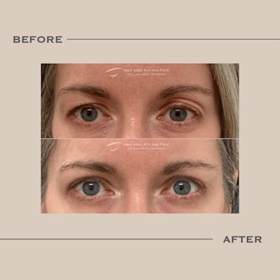 Upper Blepharoplasty Before & After Gallery - Patient 239361 - Image 1