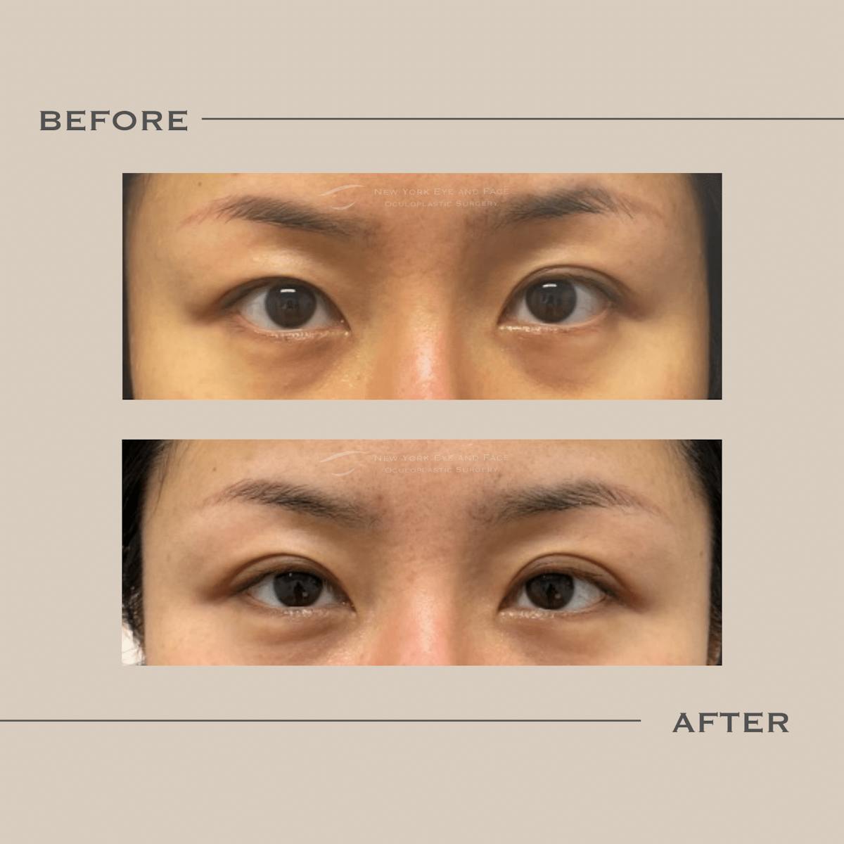 double eyelid surgery before and after