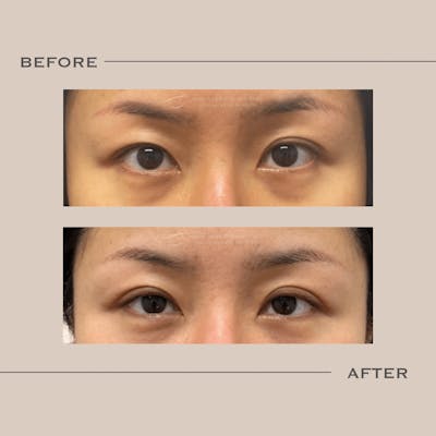 Upper Blepharoplasty Before & After Gallery - Patient 151828 - Image 1