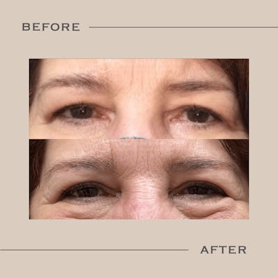 Upper Blepharoplasty Before & After Gallery - Patient 225127 - Image 1