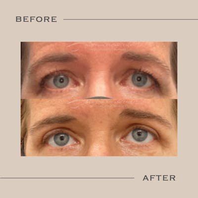 Upper Blepharoplasty Before & After Gallery - Patient 197481 - Image 1