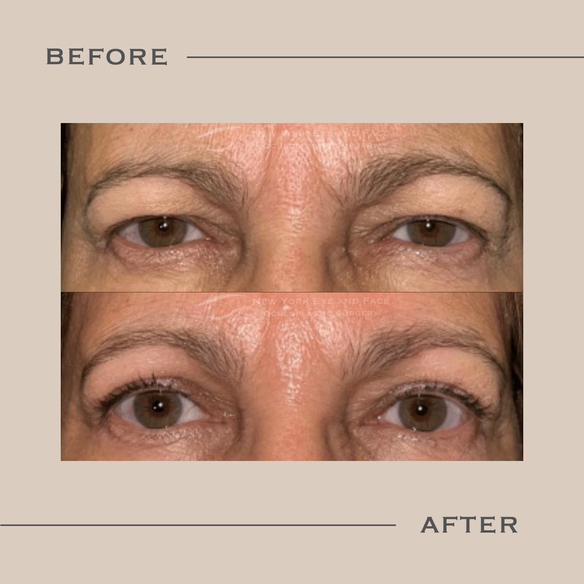 Upper Blepharoplasty Before & After Gallery - Patient 250694 - Image 1