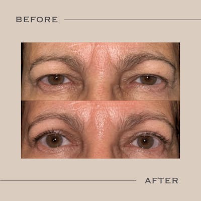 Upper Blepharoplasty Before & After Gallery - Patient 250694 - Image 1