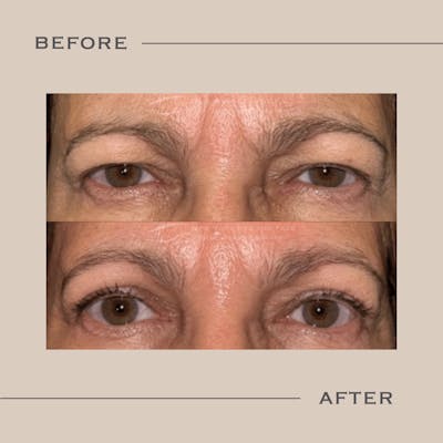 Upper Blepharoplasty Before & After Gallery - Patient 250694 - Image 1