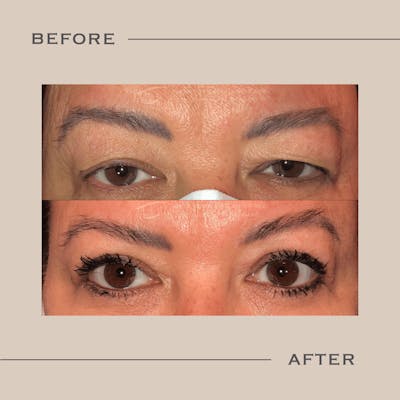 Upper Blepharoplasty Before & After Gallery - Patient 315127 - Image 1