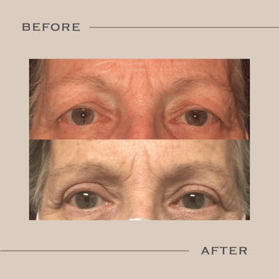 Upper Blepharoplasty Before & After Gallery - Patient 235476 - Image 1