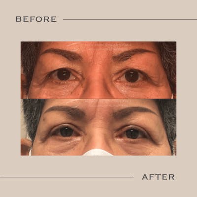 Upper Blepharoplasty Before & After Gallery - Patient 279973 - Image 1
