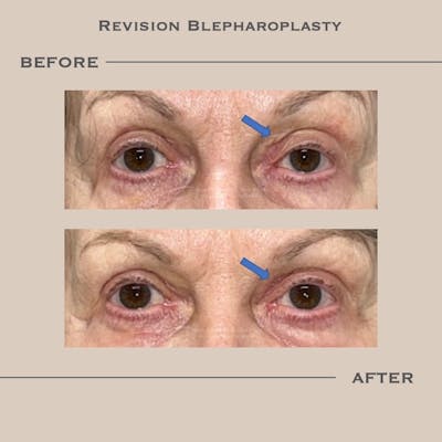 Upper Blepharoplasty Before & After Gallery - Patient 815041 - Image 1