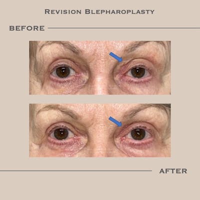 Revision Blepharoplasty Before & After Gallery - Patient 250954 - Image 1