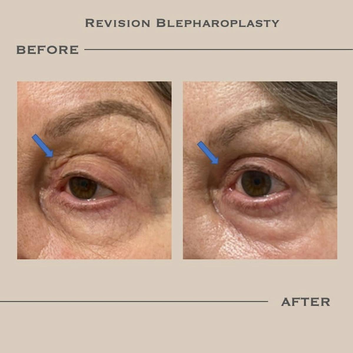 Revision Blepharoplasty Before & After Gallery - Patient 606330 - Image 1