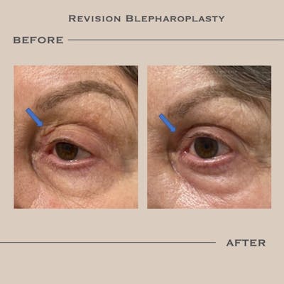 Revision Blepharoplasty Before & After Gallery - Patient 606330 - Image 1