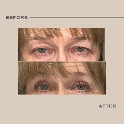 Upper Blepharoplasty Before & After Gallery - Patient 160475 - Image 1