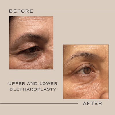 Lower Blepharoplasty Before & After Gallery - Patient 393868 - Image 1
