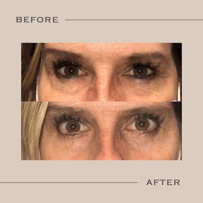 Lower Blepharoplasty Before & After Gallery - Patient 351971 - Image 1
