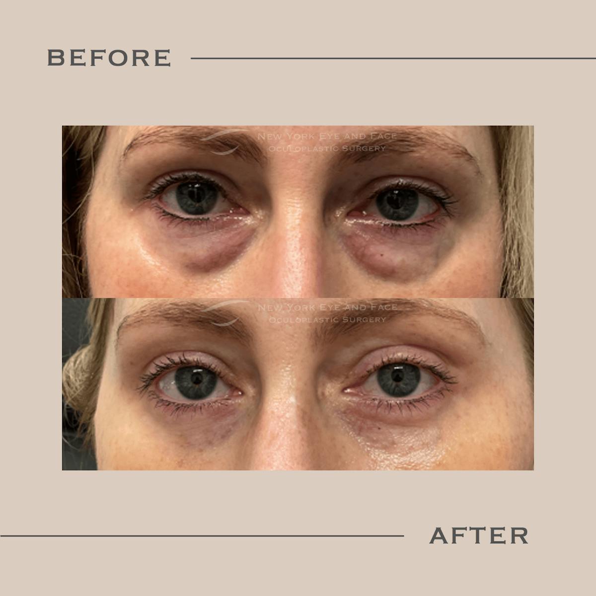 Lower Blepharoplasty Before & After Gallery - Patient 266976 - Image 1